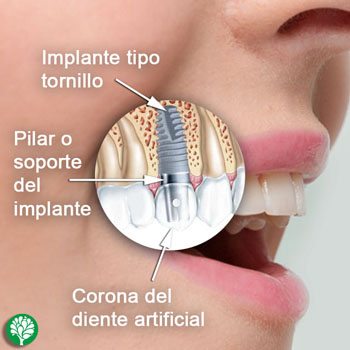 implante_dental