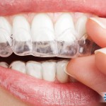 invisalign