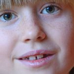 Dientes separados