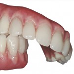 protesis_dental