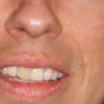 Las causas principales de la pérdida de esmalte dental